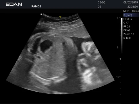 УЗИ аппарат Edan Acclarix AX3 фото 36