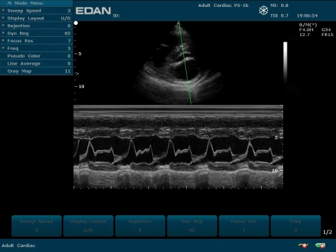 УЗИ аппарат Edan U50 Prime Edition фото 41