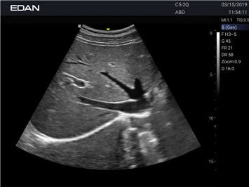 УЗИ аппарат Edan Acclarix AX2 фото 9