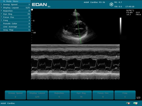 УЗИ аппарат Edan U50 Prime Edition фото 44