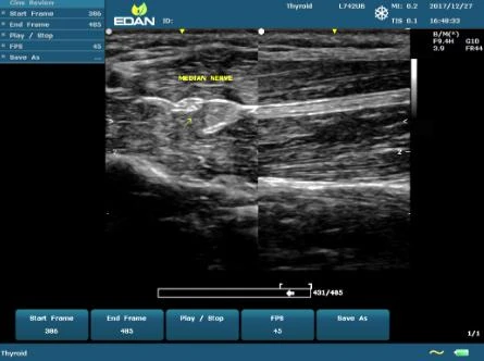 УЗИ аппарат Edan U60 фото 42