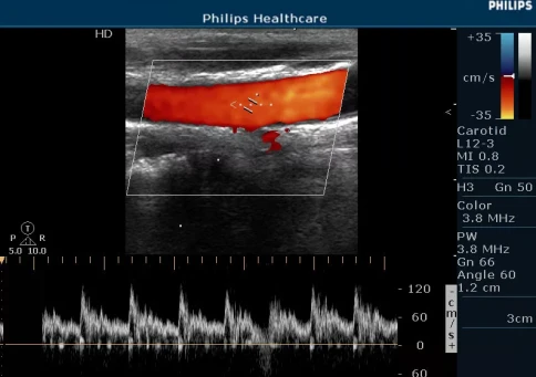 УЗИ аппарат Philips HD5 фото 6