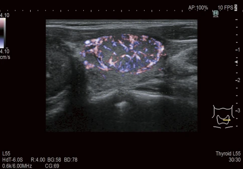 УЗИ аппарат Fujifilm Lisendo 880LE фото 4