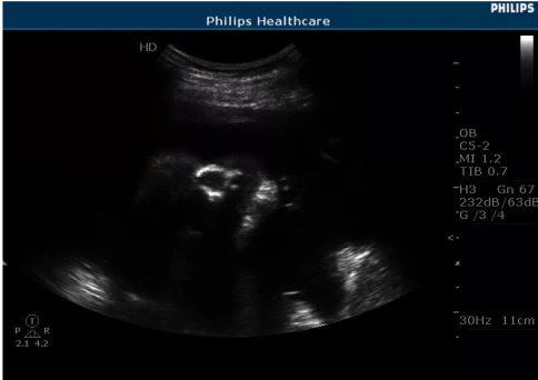 УЗИ аппарат Philips HD5 фото 3