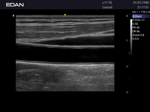 УЗИ аппарат Edan Acclarix AX3 фото 60