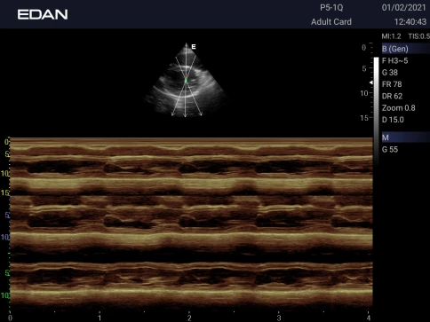 УЗИ аппарат Edan Acclarix AX3 фото 27