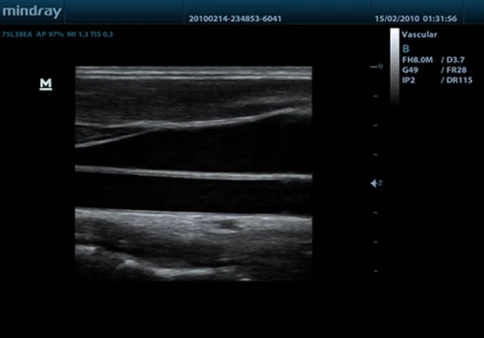 УЗИ аппарат Mindray DP-50 фото 8