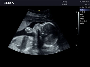 УЗИ аппарат Edan Acclarix LX3 фото 32