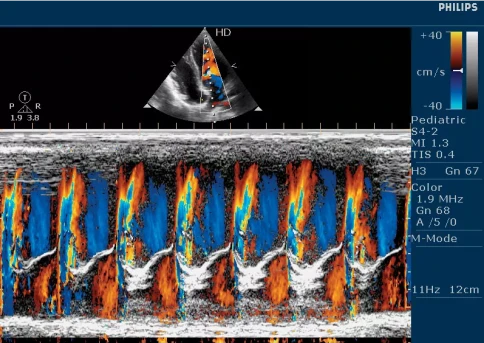 УЗИ аппарат Philips HD5 фото 5