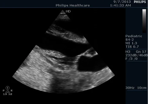 УЗИ аппарат Philips HD5 фото 11