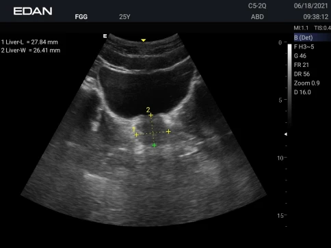 УЗИ аппарат Edan Acclarix AX3 фото 47