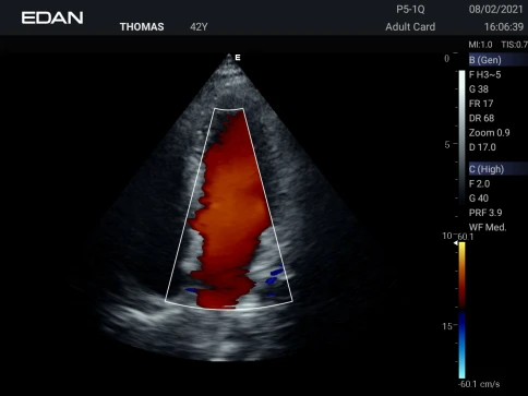 УЗИ аппарат Edan Acclarix AX3 фото 7