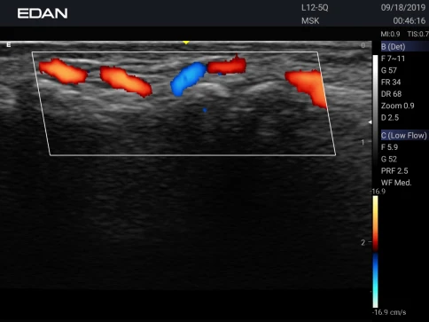УЗИ аппарат Edan Acclarix AX3 фото 57