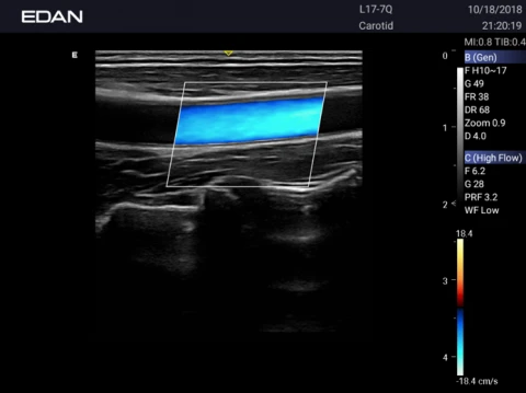 УЗИ аппарат Edan Acclarix AX3 фото 59
