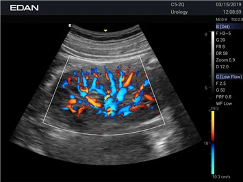 УЗИ аппарат Edan Acclarix AX2 фото 2