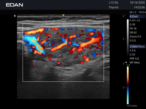 УЗИ аппарат Edan Acclarix AX3 фото 29