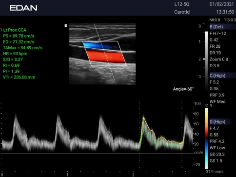 УЗИ аппарат Edan Acclarix AX3 фото 6