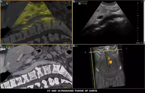 УЗИ аппарат Philips EPIQ PercuNav фото 5