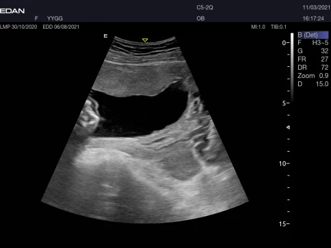 УЗИ аппарат Edan Acclarix AX3 фото 40