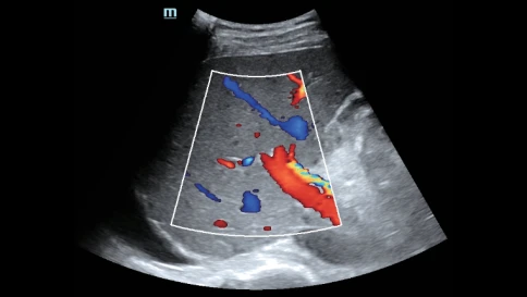 Mindray Hepatus 5 ультразвуковая система фибросканирования печени фото 6