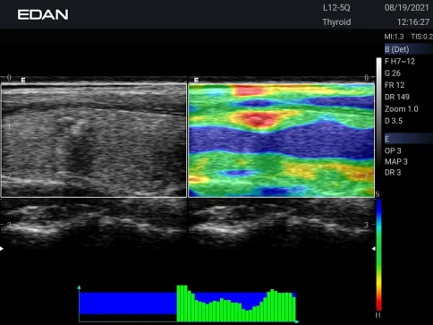 УЗИ аппарат Edan Acclarix AX3 фото 55
