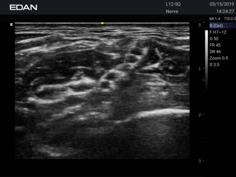 УЗИ аппарат Edan Acclarix AX3 фото 25