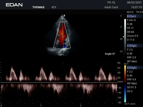 УЗИ аппарат Edan Acclarix AX3 фото 9