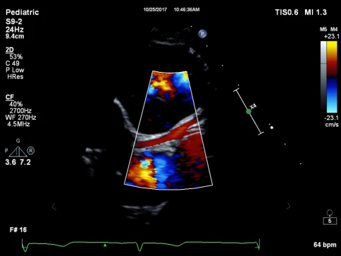 УЗИ аппарат Philips EPIQ CVx фото 5