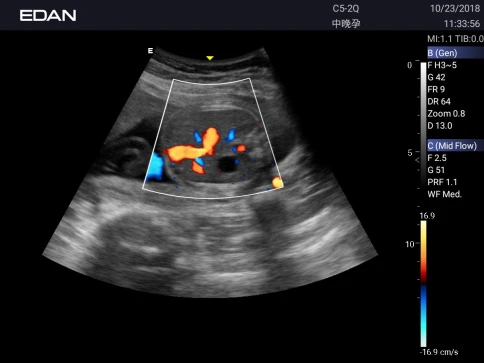 УЗИ аппарат Edan Acclarix AX3 фото 49
