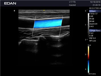 УЗИ аппарат Edan Acclarix AX2 фото 5