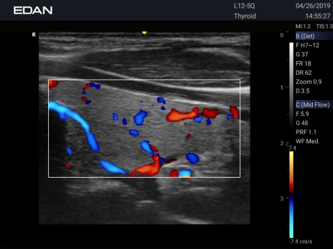 УЗИ аппарат Edan Acclarix AX3 фото 30