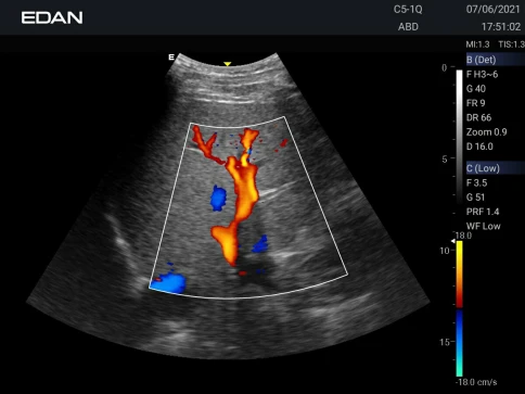 УЗИ аппарат Edan Acclarix AX3 фото 17