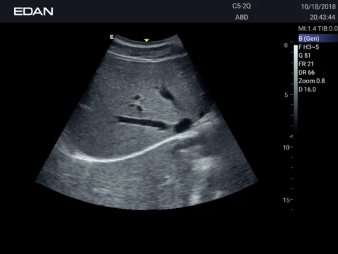 УЗИ аппарат Edan Acclarix AX3 фото 65