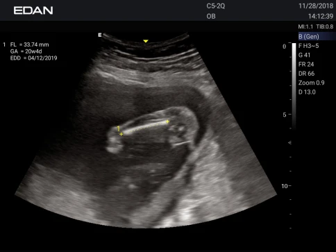 УЗИ аппарат Edan Acclarix AX3 фото 38