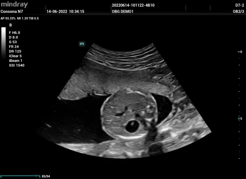 Ультразвуковая система Mindray Consona N7P фото 19