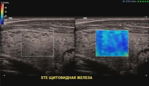 Ультразвуковой аппарат Mindray Resona I9 Exp фото 15