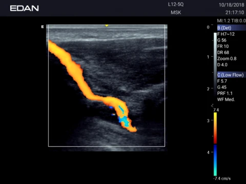 УЗИ аппарат Edan Acclarix AX3 фото 62