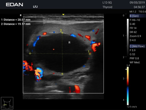 УЗИ аппарат Edan Acclarix AX3 фото 32