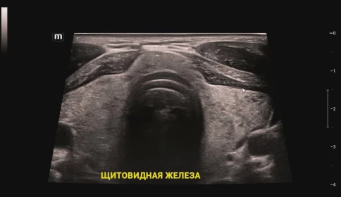 Ультразвуковой аппарат Mindray Resona I9 Exp фото 8