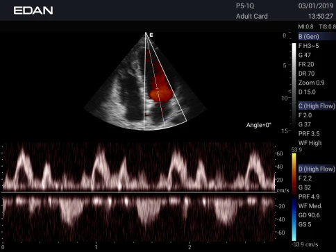 УЗИ аппарат Edan Acclarix AX3 фото 13