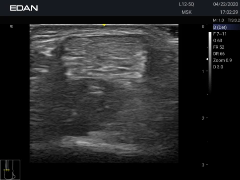 УЗИ аппарат Edan Acclarix AX3 фото 16