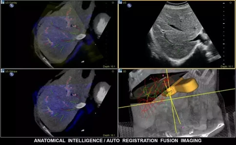 УЗИ аппарат Philips EPIQ PercuNav фото 3