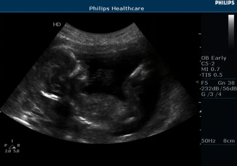 УЗИ аппарат Philips HD5 фото 7