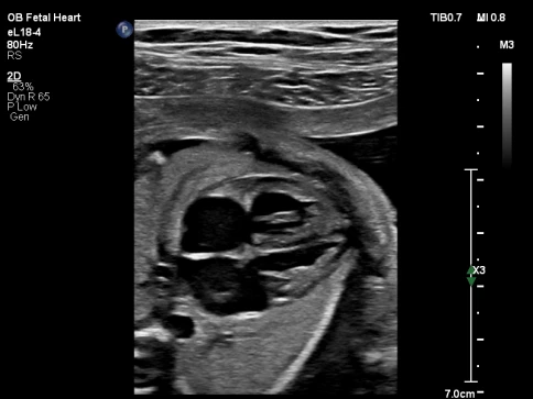 УЗИ аппарат Philips EPIQ CVx фото 6