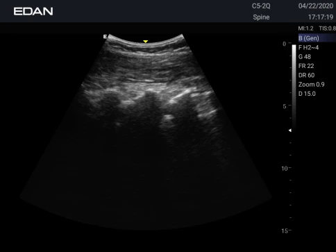 УЗИ аппарат Edan Acclarix AX3 фото 21