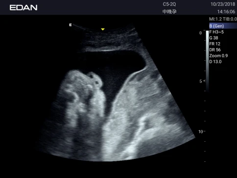 УЗИ аппарат Edan Acclarix AX3 фото 35