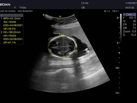 УЗИ аппарат Edan Acclarix AX3 фото 39