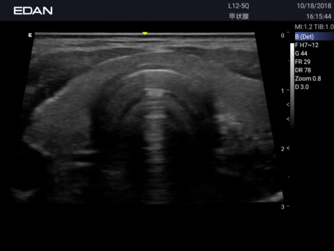 УЗИ аппарат Edan Acclarix AX3 фото 61
