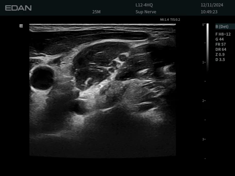 Ультразвуковая система Edan Acclarix LX85 фото 17