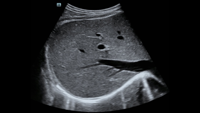 Mindray Hepatus 5 ультразвуковая система фибросканирования печени фото 7